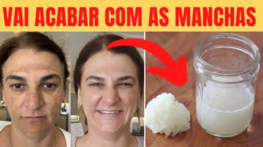 Melasma no Rosto - Faça Isso Para Acabar com Melasma em 15 dias | Manchas Escuras na Pele