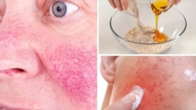 5 FORMAS DE ELIMINAR A ROSÁCEA NATURALMENTE