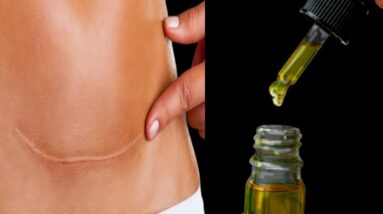 As estrias e cicatrizes desaparecem para sempre: apenas 3 ingredientes!