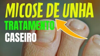 MICOSE DE UNHA COMO TRATAR ONICOMICOSE OU MICOSE DE UNHA