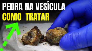 ESSA É A MELHOR MANEIRA DE TRATAR PEDRA NA VESÍCULA