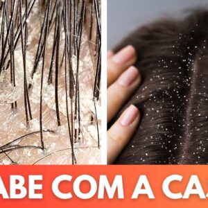 Os melhores truques naturais para dizer adeus à caspa de uma vez por todas!