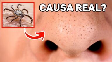Esta é a Verdadeira Causa de Seus Cravos (e Como Se Livrar Deles de Uma Vez por Todas!)