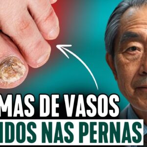 9 SINAIS DE VEIAS ENTUPIDAS NAS PERNAS. Como verificar em casa sem médico?