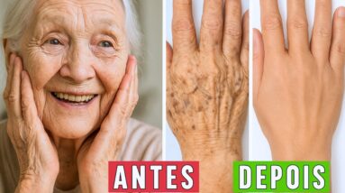 Como Acabar Com as MANCHAS na PELE Naturalmente (Inclusive MELASMA)