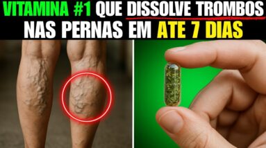 Inacreditável! 🤩 É um matador de varizes! Apaga as varizes como uma borracha!🔝vitamina + 1 receita