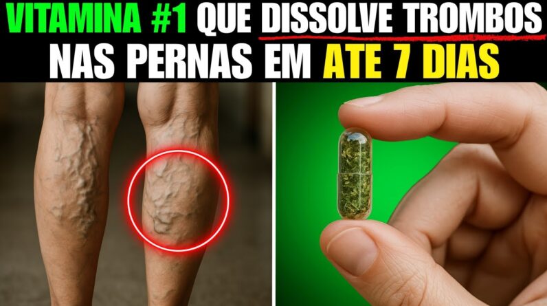 Inacreditável! 🤩 É um matador de varizes! Apaga as varizes como uma borracha!🔝vitamina + 1 receita